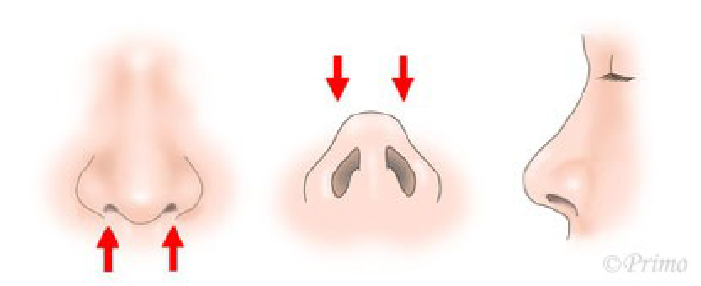 鼻尖縮小術の注意点