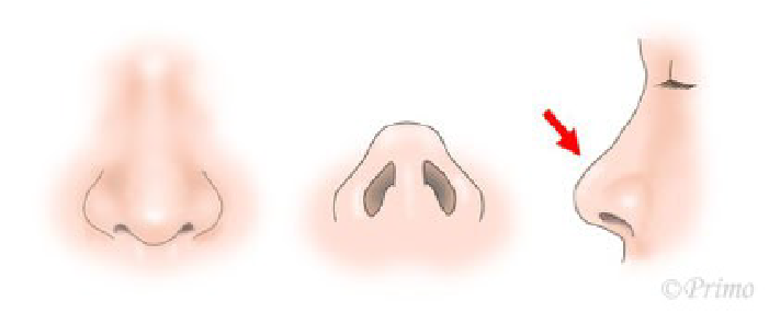 鼻尖縮小術の注意点