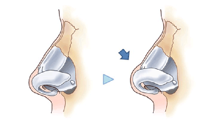 鼻尖縮小術3D法の方法