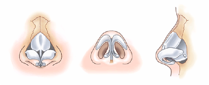 鼻尖縮小術3D法の方法