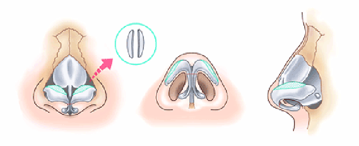 鼻尖縮小術3D法の方法