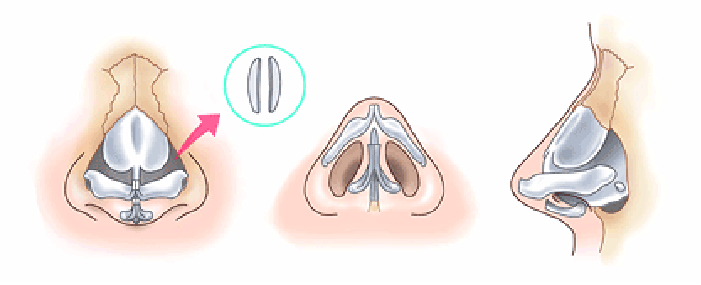 鼻尖縮小術3D法の方法