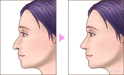 鷲鼻形成術 鼻の整形 プリモ麻布十番クリニック