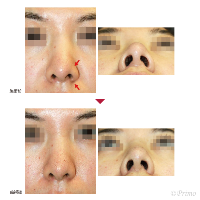 B 鼻尖形成術（軟骨移植）＋左鼻翼縮小術 症例経過写真