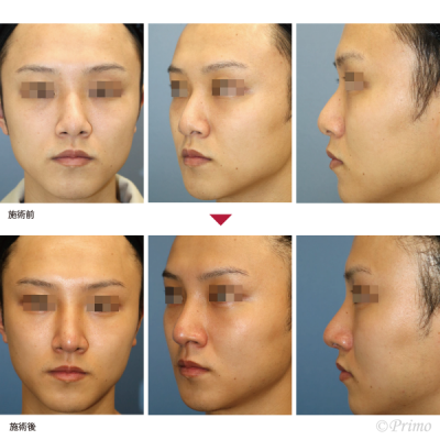 DV 鼻中隔延長術＋鼻尖縮小術＋隆鼻術＋眉間プロテーゼ手術 症例経過写真