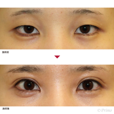 T 眼瞼下垂手術 症例経過写真