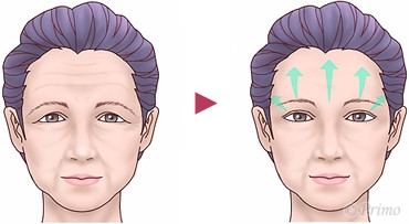 前額リフト エイジングケア プリモ麻布十番クリニック