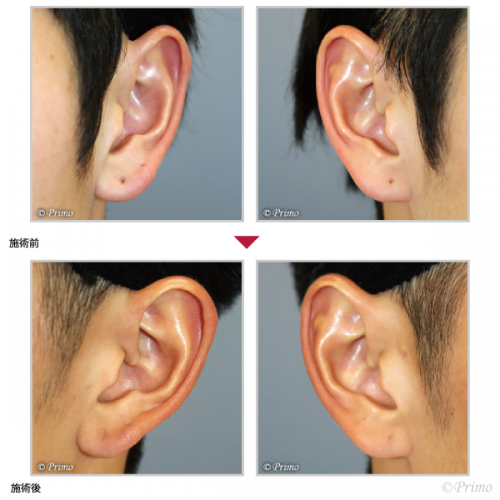 耳ピアス修正術 ピアスホール修正 耳の整形 プリモ麻布十番クリニック