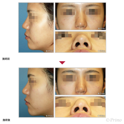 B 鼻尖縮小術（3D法）＋鼻孔縁挙上術 症例経過写真