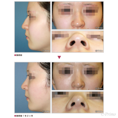C 整鼻術＋鼻尖縮小術＋鼻翼縮小術（内側法） 症例経過写真