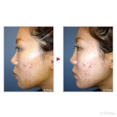 A ハイドロキシアパタイト注入鼻とアゴ 症例経過写真