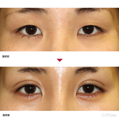 X 全切開+上眼瞼脱脂術 症例経過写真