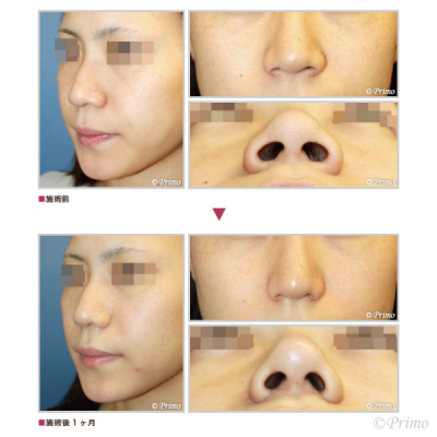 D 鼻翼縮小術（内側法＋外側法） 症例経過写真