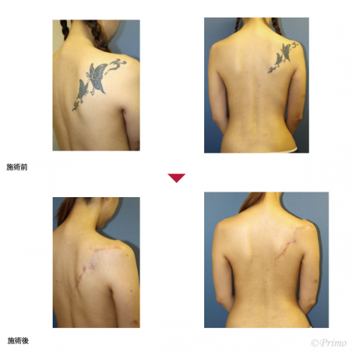刺青除去術 タトゥー除去 症例一覧 プリモ麻布十番クリニック