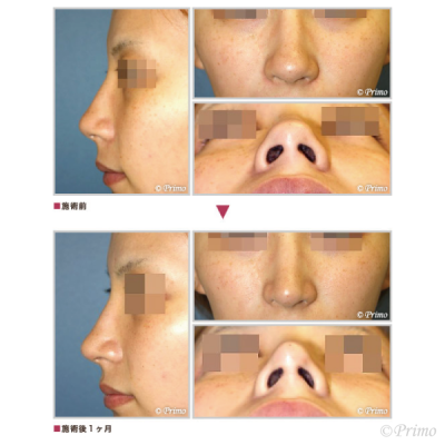 A 鼻尖縮小術（3D法） 症例経過写真