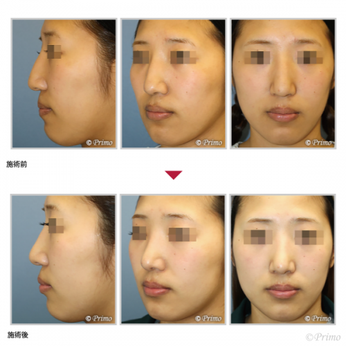 鼻尖挙上術 鼻尖吊り上げ術 鼻の整形 プリモ麻布十番クリニック