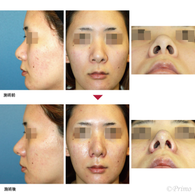 F 鼻尖縮小術（3D法）＋鼻翼縮小術（内側法） 症例経過写真