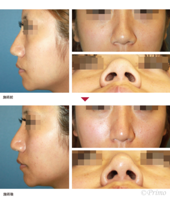 A 鼻尖縮小術（3D法）＋鼻翼縮小術（内側法）＋鼻孔縁挙上術 症例経過写真