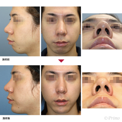 C アゴプロテーゼ＋鼻尖縮小術 症例経過写真