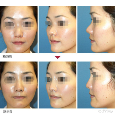 ヒアルロン酸注入 症例経過写真