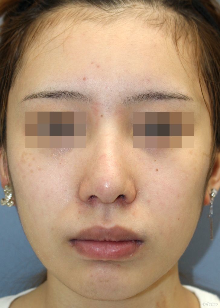 Dr 大場の鼻の修正手術ブログ 鼻修正の美容整形なら プリモ麻布十番クリニック Part 10