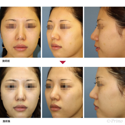 EA 鼻中隔延長術＋他院鼻プロテーゼ入れ替え術＋眉間プロテーゼ手術＋アゴプロテーゼ手術 症例経過写真