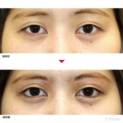 CE 下眼瞼拡大術＋目尻切開＋上眼瞼リフト 症例経過写真
