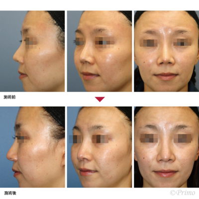 EZ 鼻中隔延長術＋他院鼻プロテーゼ入れ替え術＋眉間プロテーゼ 症例経過写真