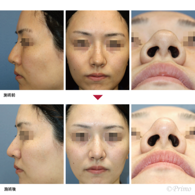 P 鼻尖縮小術（3D法） 症例経過写真