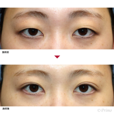 BM 全切開+上眼瞼脱脂術 症例経過写真