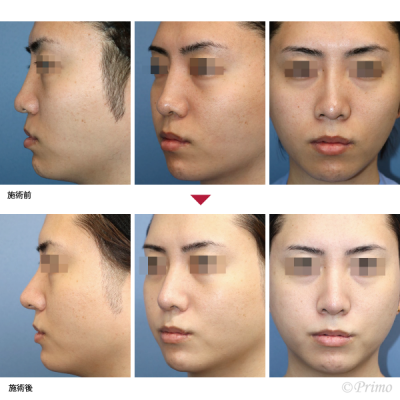 FK 鼻中隔延長術＋他院鼻プロテーゼ入れ替え術＋眉間プロテーゼ 症例経過写真