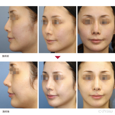 FL 鼻中隔延長術＋他院鼻プロテーゼ入れ替え術（特別注文プロテーゼ）＋眉間プロテーゼ 症例経過写真