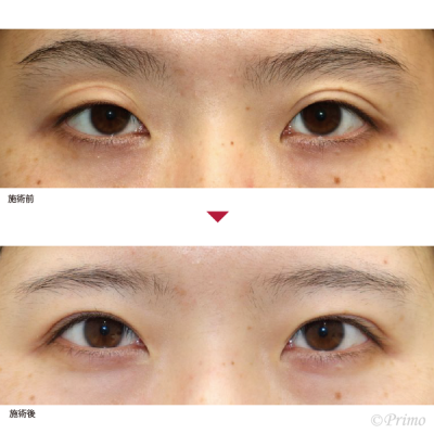 CM 二重修正術（重瞼修正切開術）6ヶ月後右眼瞼下垂手術 症例経過写真