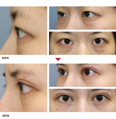 CN 眼瞼下垂手術＋ROOF切除術＋目頭切開＋目尻切開＋下眼瞼拡大術＋下眼瞼脱脂術＋逆さまつげ手術 症例経過写真