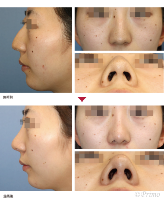 L 整鼻術＋鼻尖縮小術3D法（鼻尖縮小術＋鼻翼軟骨移植術） 症例経過写真