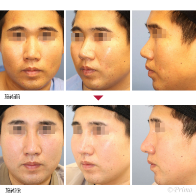 FW 鼻中隔延長術（肋軟骨）＋鼻尖縮小術＋隆鼻術＋眉間プロテーゼ（オーダーメイドプロテーゼ） 症例経過写真