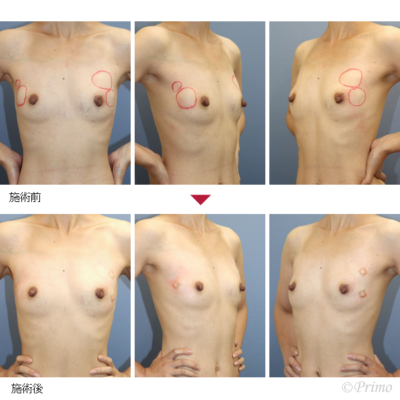 他院胸部ヒアルロン酸注入後しこり除去 術前後写真