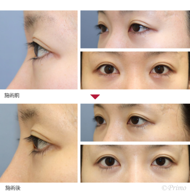 DH 下眼瞼拡大術（たれ目形成）＋下眼瞼脱脂術（結膜側）＋下眼瞼逆さまつ毛手術 症例経過写真