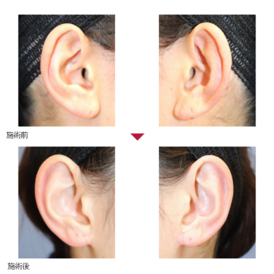 A 耳垂縮小術＋左立ち耳手術 症例経過写真