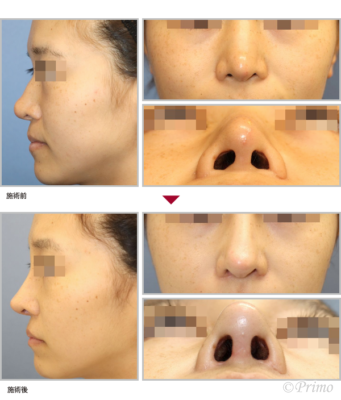 E 鼻中隔延長術＋隆鼻術＋眉間プロテーゼ（オーダーメイド）＋鼻翼修正術＋整鼻術＋鼻翼基部プロテーゼ手術 症例経過写真