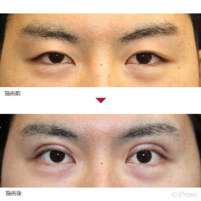CP 全切開＋上眼瞼脱脂術＋ROOF切除術 症例経過写真