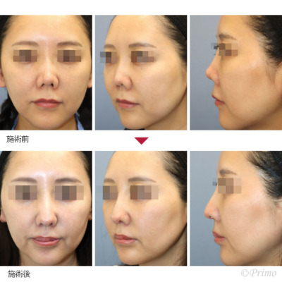 GS 鼻中隔延長術＋他院鼻プロテーゼ入れ替え術＋眉間プロテーゼ（特別注文プロテーゼ） 症例経過写真