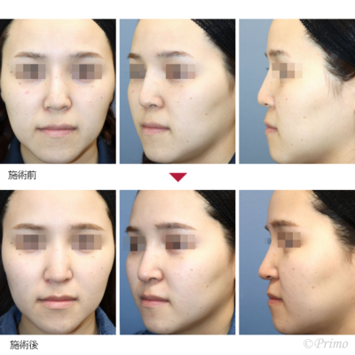 GY 鼻中隔延長術＋他院鼻プロテーゼ入れ替え術＋眉間プロテーゼ（特別注文プロテーゼ） 症例経過写真
