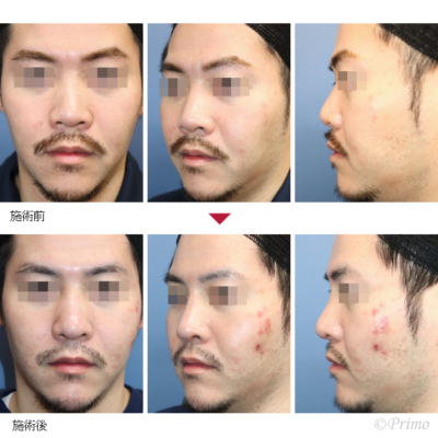 HB 鼻中隔延長術＋隆鼻術＋眉間プロテーゼ（特別注文プロテーゼ） 症例経過写真