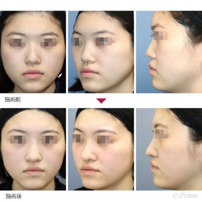 GU 鼻中隔延長術＋隆鼻術＋眉間プロテーゼ（特別注文プロテーゼ） 症例経過写真