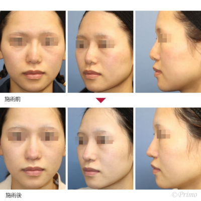 GW 鼻中隔延長術＋他院鼻プロテーゼ入れ替え術＋眉間プロテーゼ（特別注文プロテーゼ） 症例経過写真
