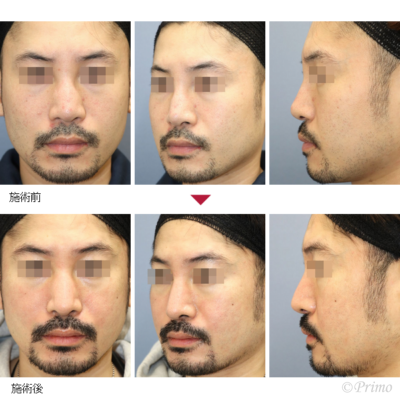 GP 鼻中隔延長術＋隆鼻術＋眉間プロテーゼ（特別注文プロテーゼ）＋アクアミド除去 症例経過写真