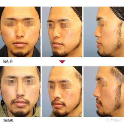 HP 鼻中隔延長術＋隆鼻術＋眉間プロテーゼ 症例経過写真
