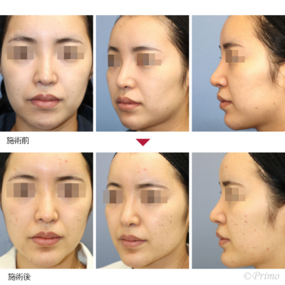 E アゴプロテーゼ 症例経過写真