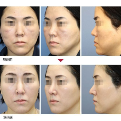 ID 鼻中隔延長術＋隆鼻術＋眉間プロテーゼ（特別注文プロテーゼ） 症例経過写真